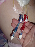 Phoresis Catheter