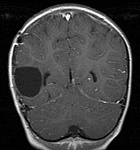 This is a slice from Abby's Jan 20, 2005 MRI.  The gray circle in the left center indicates where the tumor was.  The lack of any bright spots suggests no additional tumor activity.